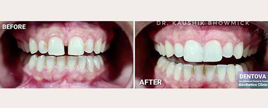 Jaw alignment and smile correction surgery before and after at Dentova Guwahati