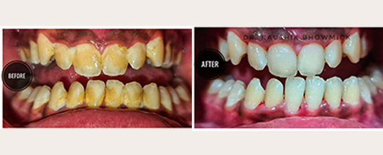 Severe dental misalignment and discoloration corrected at Dentova Guwahati